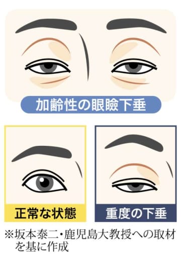 眠そうな目をしているね…それ眼瞼下垂かも　加齢で発症、まぶた上がらず視界も狭く、頭痛に肩こり　たるんだ皮膚切除する中高年層増えてます　鹿児島大学病院