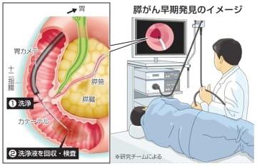 胃カメラ検査で膵がん診断、阪大　遺伝子変異を検出、早期発見期待