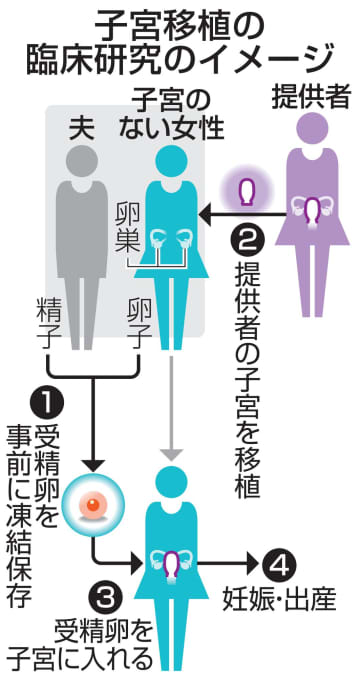 慶大、子宮移植の実施計画を承認　出産目的の女性対象、国内初