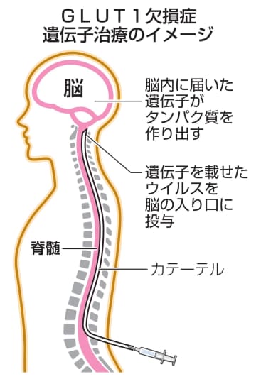 脳の難病患者に遺伝子治療　自治医大、7月から臨床試験