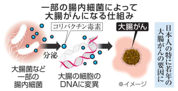 国内大腸がん、5割が細菌原因か　毒素で変異、若年発症増に関係も