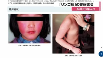 石川県で『リンゴ病』の警報発令…コロナ禍前の2019年以来の発令に妊婦などへ注意呼びかけ